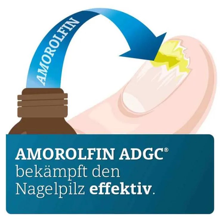 Amorolfin ADGC 50 mg / ml wirkstoffhalt.Nagellack, 5 ml